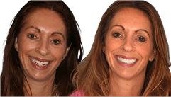 Emma's Invisalign before and after results